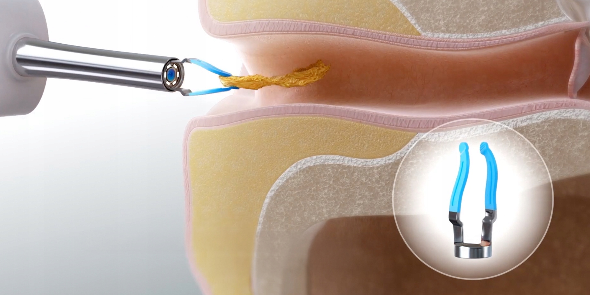 Rinkinys išmanusis otoskopas su kamera ausų valymui Bebird Earsight Plus belsilt Rinkinys išmanusis otoskopas su kamera ausų valymui Bebird Earsight Plus